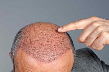 Goedkope haartransplantatie bij de beste klinieken?