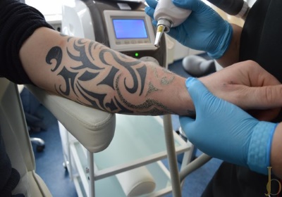 Laat uw tattoo verwijderen door een specialist!